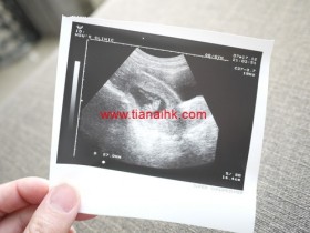 去香港做胎儿性别鉴定准吗？
