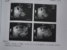 香港验Y基因检测胎儿性别靠谱吗