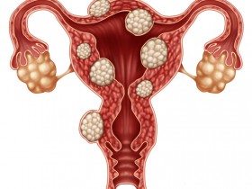 子宫肌瘤会影响怀孕吗？