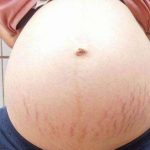 妊娠纹可以判断胎儿性别吗？