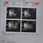香港验Y基因检测胎儿性别靠谱吗