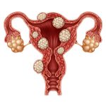 子宫肌瘤会影响怀孕吗？